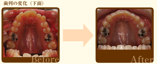 歯列の変化下面